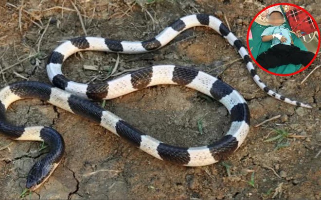 B&eacute; 5 tuổi bị suy h&ocirc; hấp nặng do rắn cạp nia cắn - Ảnh 1.