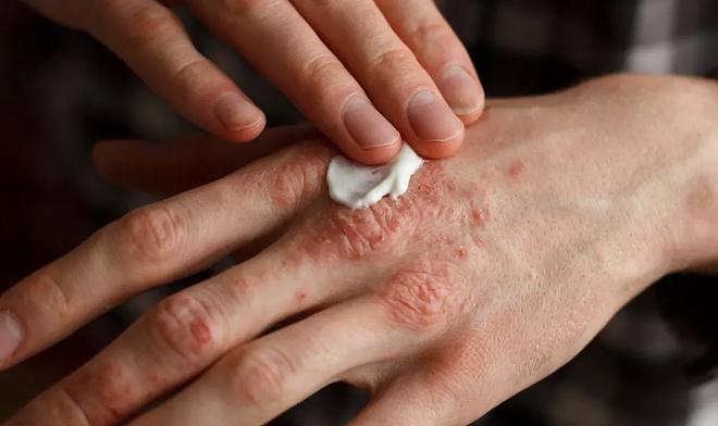 C&aacute;ch kiểm so&aacute;t da kh&ocirc; trong m&ugrave;a đ&ocirc;ng - Ảnh 5.