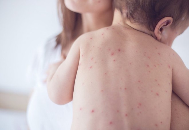 Dịch sốt xuất huyết lớn có nguy cơ xảy ra vào cuối năm 2022: Cảnh báo những đối tượng mắc sốt xuất huyết dễ bị trở nặng - Ảnh 3.