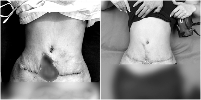 Hút mỡ bụng hỏng, nữ bệnh nhân bị hoại tử với vết thủng 10cm giữa bụng - Ảnh 1.