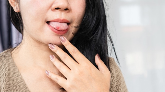 Người phụ nữ 39 tuổi phải cắt bỏ lưỡi sau khi bị ung thư giai đoạn 3, bác sĩ cảnh báo dấu hiệu phát hiện bệnh mà nhiều người bỏ qua - Ảnh 2.