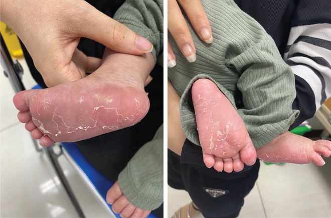 B&eacute; 18 th&aacute;ng tuổi mắc bệnh giang mai, b&aacute;c sĩ chỉ ra con đường l&acirc;y nhiễm của trẻ - Ảnh 1.