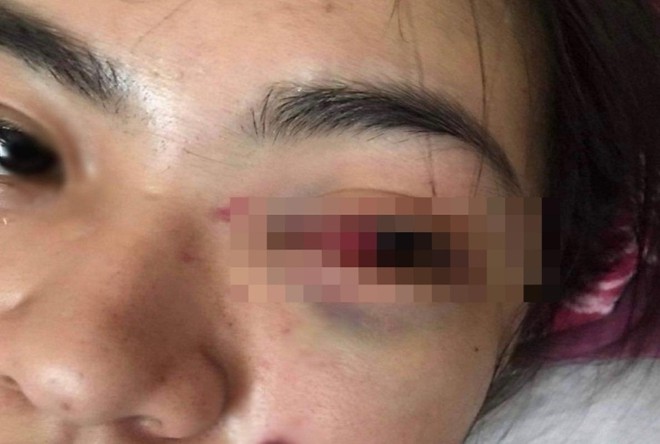 H&agrave; Tĩnh: Nữ sinh lớp 11 bị nh&oacute;m bạn đ&aacute;nh tụ m&aacute;u mắt - Ảnh 1.