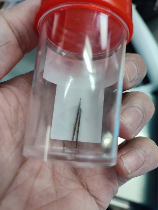 B&aacute;c sĩ kịp thời gắp kim may quần &aacute;o trong phổi b&eacute; trai 4 tuổi - Ảnh 3.