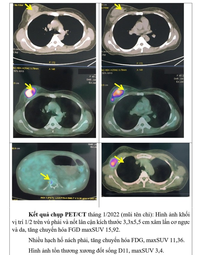 Trì hoãn đi viện vì sợ Covid-19, người phụ nữ mắc ung thư vú chuyển giai đoạn cuối, bác sĩ lưu ý điều gì? - Ảnh 2.
