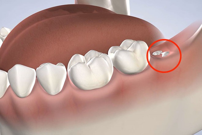 Vì sao luôn mọc ở chỗ không ai muốn, gây đau đớn nhưng răng khôn lại được đặt cái tên “thông minh” như vậy? Đáp án thật ra rất hợp lý - Ảnh 3.