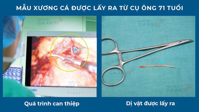 Cụ ông suýt chết vì bị xương cá xuyên thủng dạ dày - Ảnh 1.