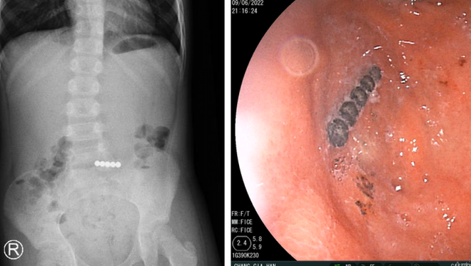 Bé gái 6 tuổi nhập viện cấp cứu do nuốt 5 viên bi nam châm - Ảnh 1.