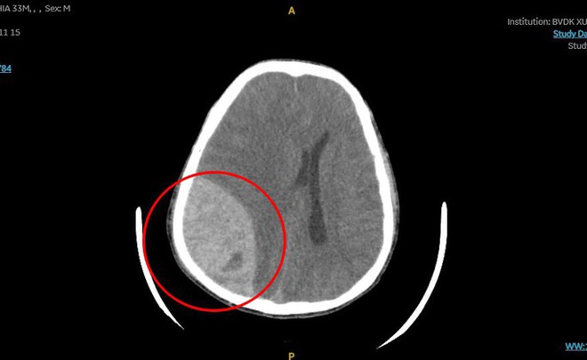Hy hữu: Người đàn ông bị xuất huyết não sau khi đi bơi - Ảnh 2.