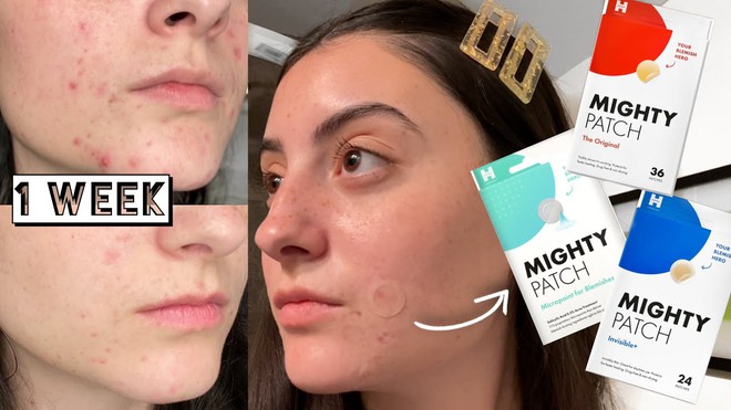 Dùng thử miếng dán trị mụn 300k, cô gái ước gì mình được trải nghiệm sớm hơn - Ảnh 1.