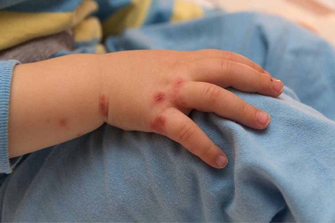 Trẻ bị chân tay miệng có 3 dấu hiệu này cần nhập viện gấp - Ảnh 3.