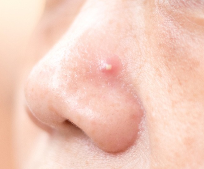 Mụn mọc tại 8 vị trí này bắt nguồn từ các thói quen nhiều người mắc - Ảnh 2.