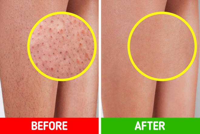 6 c&aacute;ch tự cải thiện l&agrave;n da vi&ecirc;m nang l&ocirc;ng tại nh&agrave; - Ảnh 3.