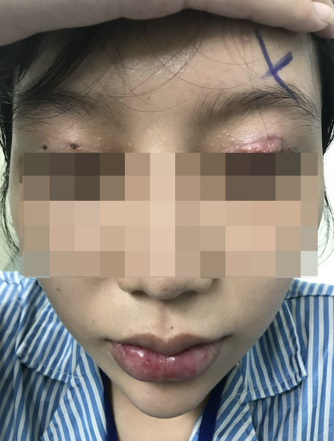 Cắt mí mắt ở cơ sở thẩm mỹ chui, một phụ nữ bị hỏng mắt - Ảnh 1.