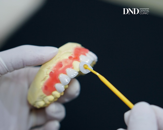 Quy trình dán sứ veneer: Đơn giản và ít phải mài hơn làm răng sứ, nhưng cũng khó nhằn ra phết - Ảnh 3.