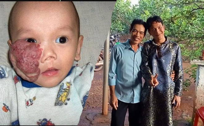 Cuộc hồi hương sau 16 năm của cậu b&eacute; gốc Việt c&oacute; khối u che nửa mặt được mẹ Mỹ nhận nu&ocirc;i - Ảnh 1.
