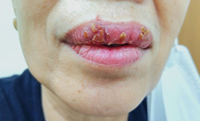 Vì sao phun môi bị viêm sưng Long huyết PH tan bầm tím giảm sưng đau #21 Vì sao phun môi bị viêm sưng Long huyết PH tan bầm tím giảm sưng đau