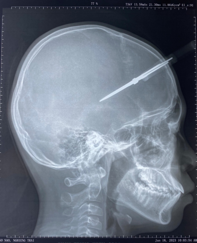 Phẫu thuật thành công cho cháu bé bị kéo đâm thủng hộp sọ - Ảnh 1.