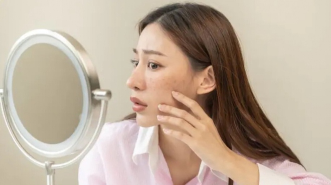 Biện ph&aacute;p l&agrave;m mờ sẹo mụn tại nh&agrave; để c&oacute; l&agrave;n da căng mọng đ&oacute;n Tết - Ảnh 2.