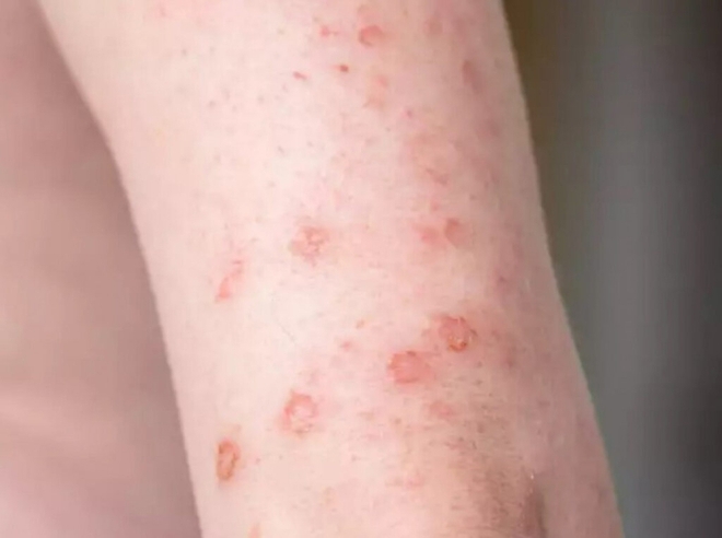 Nam thanh ni&ecirc;n ở TP.HCM trả gi&aacute; đắt v&igrave; xả stress ở qu&aacute;n karaoke, b&aacute;c sĩ chỉ ra 5 bệnh l&acirc;y qua đường t&igrave;nh dục nguy hiểm - Ảnh 4.