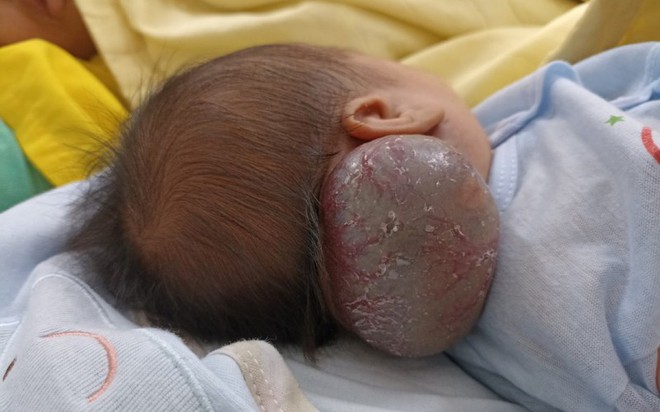 Cắt khối u máu khổng lồ, hiếm gặp cho bé sơ sinh - Ảnh 1.