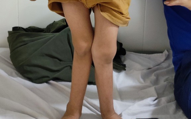 9 tuổi chưa biết đi, b&eacute; trai được ph&aacute;t hiện ống thận hiếm gặp - Ảnh 1.