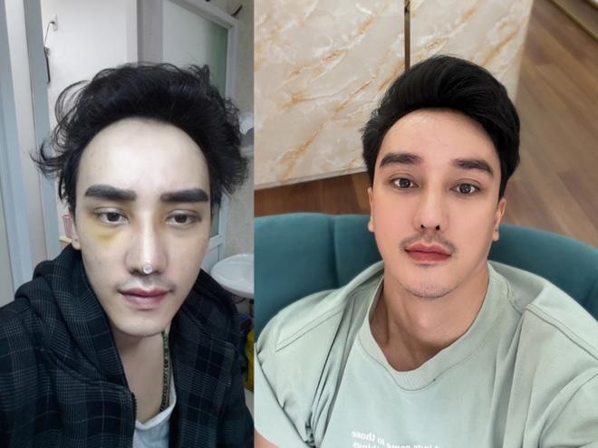 T&acirc;m sự của người đ&agrave;n &ocirc;ng nghiện phẫu thuật thẩm mỹ - Ảnh 2.