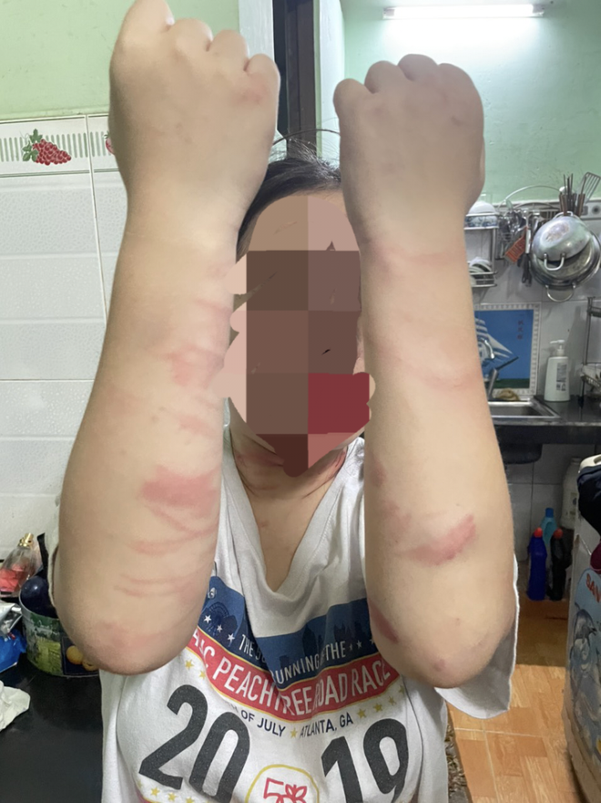 TP Hồ Ch&iacute; Minh: Điều tra vụ thiếu nữ 17 tuổi bị mẹ đ&aacute;nh g&acirc;y nhiều thương t&iacute;ch - Ảnh 1.