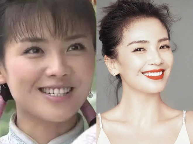 Song Hye Kyo, Lâm Tâm Như... thăng hạng nhan sắc nhờ niềng răng - Ảnh 7.