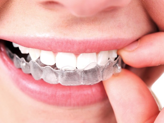 Ưu, nhược điểm của c&aacute;c phương ph&aacute;p niềng răng tr&ecirc;n thị trường: N&ecirc;n lựa chọn h&igrave;nh thức chỉnh nha n&agrave;o? - Ảnh 5.