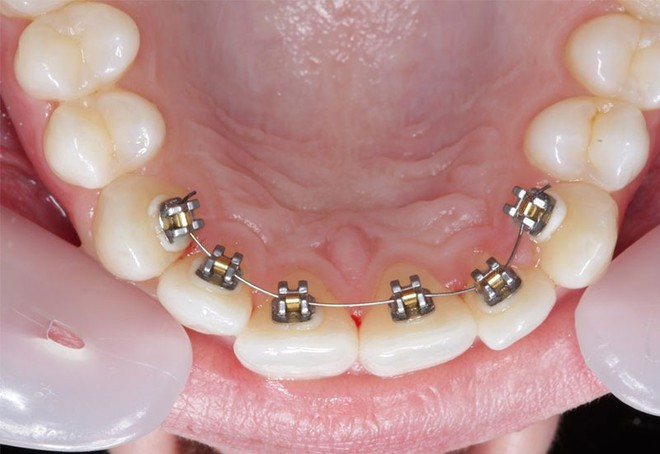 Ưu, nhược điểm của c&aacute;c phương ph&aacute;p niềng răng tr&ecirc;n thị trường: N&ecirc;n lựa chọn h&igrave;nh thức chỉnh nha n&agrave;o? - Ảnh 3.