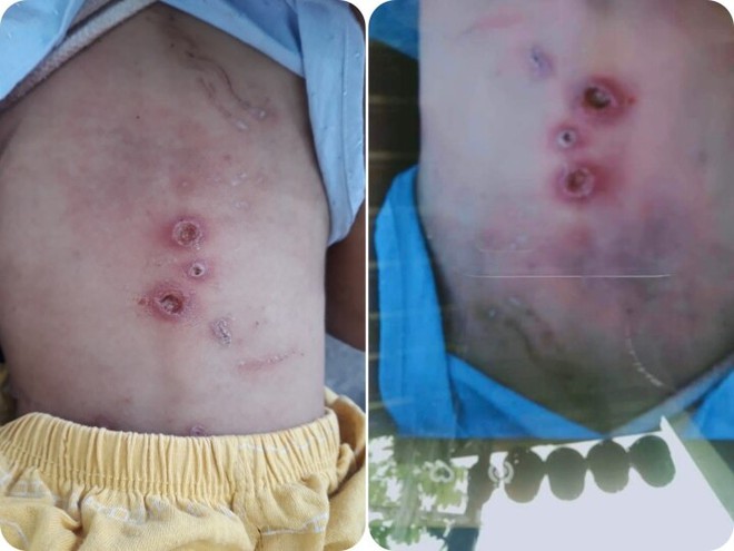 B&eacute; trai ở TP.HCM c&oacute; dấu hiệu bị bạo h&agrave;nh: Bệnh trạng c&ograve;n nặng, tiếp tục hồi sức - Ảnh 1.