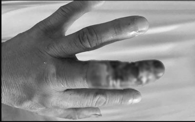 Hoại tử phải cắt bỏ ngón tay do đắp thuốc nam vào vết rắn cắn - Ảnh 1.