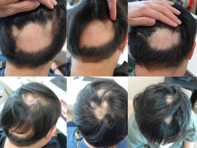 32 tuổi đ&atilde; h&oacute;i gần nửa đầu v&igrave; 2 th&oacute;i quen phổ biến, b&aacute;c sĩ chỉ ra 4 tăng 6 giảm trong thực phẩm để chống rụng t&oacute;c - Ảnh 1.