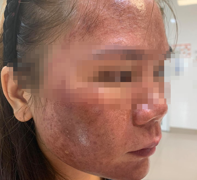 Làm đẹp da đi dự sự kiện, cô gái trẻ không dám soi gương - Ảnh 2.