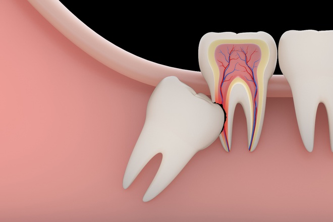 Cô gái 23 tuổi tử vong sau nhổ răng khôn: Bác sĩ chỉ ra những lưu ý tránh biến chứng nguy hiểm - Ảnh 2.