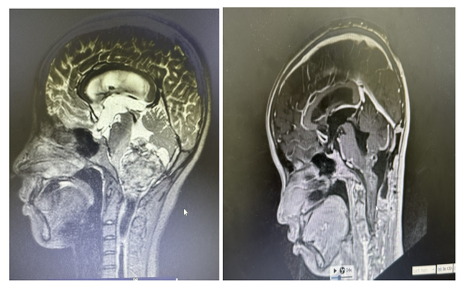 Phẫu thuật thành công cho cô gái có khối u não ở vị trí hiểm hóc - Ảnh 2.