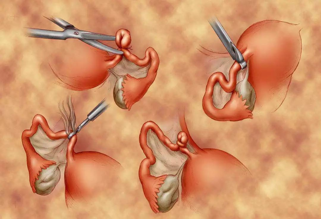 Diễn viên Diễm Hương thắt ống dẫn trứng sau sinh chỉ 4 ngày: Đây là phương pháp triệt sản an toàn và hiệu quả - Ảnh 2. Diễn viên Diễm Hương thắt ống dẫn trứng sau sinh chỉ 4 ngày: Đây là phương pháp triệt sản an toàn và hiệu quả - Ảnh 2.