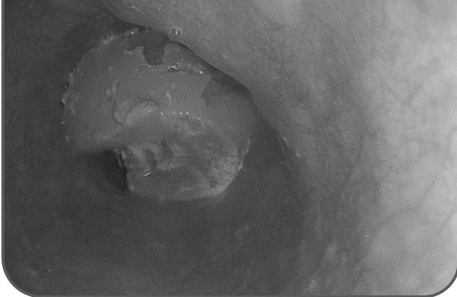 Người đ&agrave;n &ocirc;ng su&yacute;t mất mạng v&igrave; cục g&acirc;n b&ograve; 6 cm mắc trong thực quản - Ảnh 1.