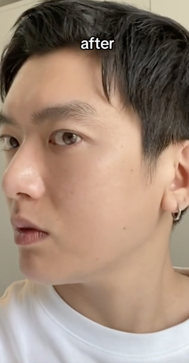 H&eacute; lộ ảnh phẫu thuật thẩm mỹ của ch&agrave;ng trai Mỹ gốc Việt Người Ấy L&agrave; Ai, diện mạo hiện tại thế n&agrave;o? - Ảnh 3.