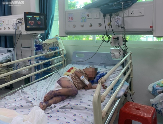 TP.HCM: Hơn 400 ca mắc tay ch&acirc;n miệng trong tuần qua - Ảnh 1.