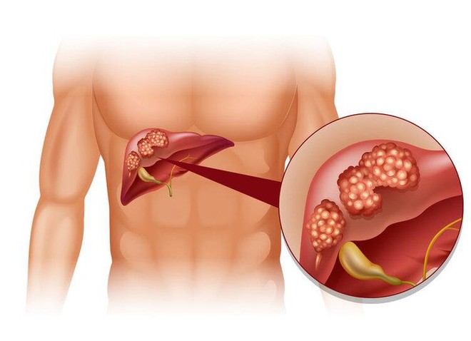 3 loại ung thư vợ chồng dễ phát triển - 1 người mắc thì người kia phải đi khám tức thì - Ảnh 3.