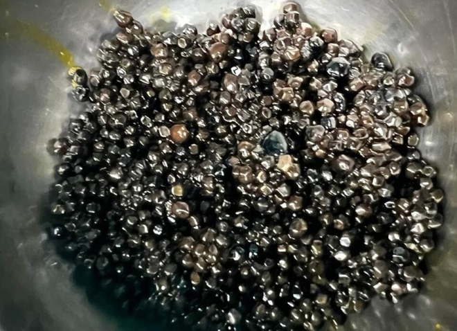 H&agrave;ng ngh&igrave;n vi&ecirc;n sỏi mật trong cơ thể cụ b&agrave; 73 tuổi - Ảnh 1.