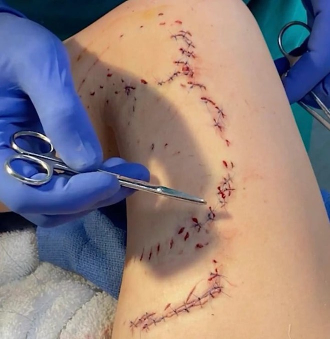 B&eacute; g&aacute;i tho&aacute;t chết sau 2 lần bị c&aacute; mập tấn c&ocirc;ng với gần trăm vết cắn - Ảnh 2.