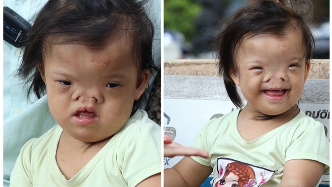 Bé 4 tuổi bị khuyết tật sọ mặt bẩm sinh cần sự giúp đỡ từ cộng đồng - Ảnh 1.