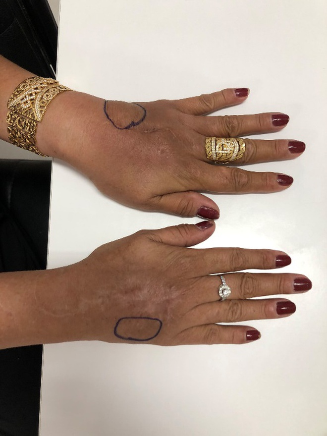 Người phụ nữ đau đớn sau 20 năm bơm silicon để được bàn tay búp măng - Ảnh 2.