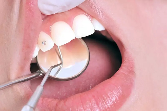 Xu hướng đính đá vào răng: Bác sĩ khuyến cáo điều quan trọng khi làm - Ảnh 3.