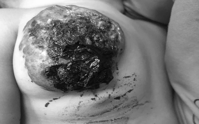 Cắt bỏ khối u mạch m&aacute;u khổng lồ hiếm gặp ở ngực b&eacute; 23 th&aacute;ng tuổi - Ảnh 1.