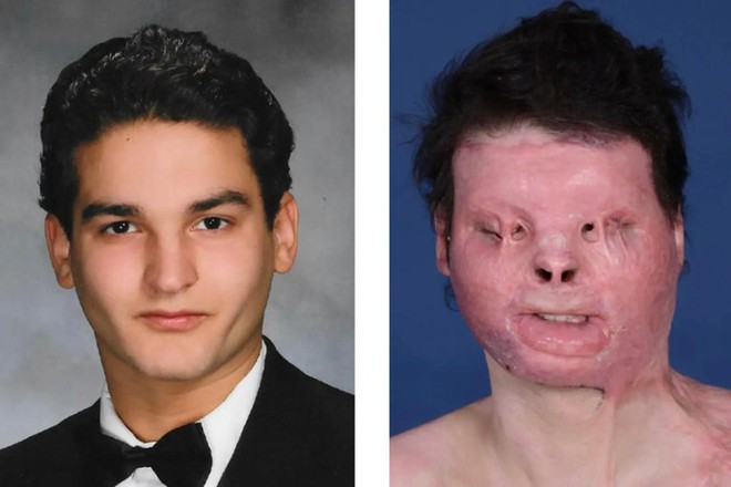 Người đầu tiên trên thế giới được phẫu thuật ghép mặt: Cuộc sống thay đổi thần kỳ sau 3 năm - Ảnh 1.