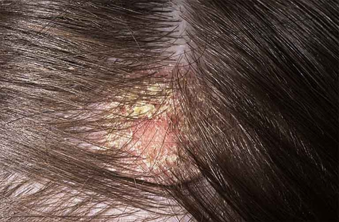 1 dấu hiệu ung thư da đầu rất giống với gàu, chủ quan bỏ qua dễ khiến bệnh nặng khó chữa - Ảnh 1.